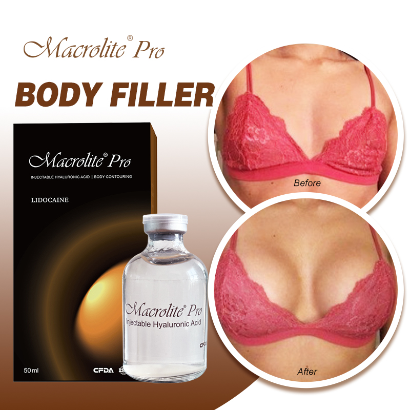 Macrolite® Pro Body Filler 50ml Before & After